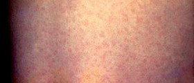 Prevention of rubella