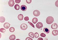 Prevention of sickle cell anaemia