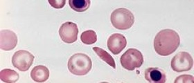 Prevention of sickle cell anaemia