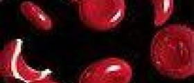 Prevention of sickle cell