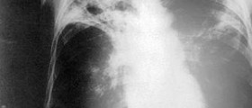 Prevention of TB in hospitals