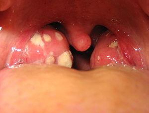 Prevention of tonsillitis