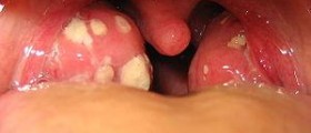 Prevention of tonsillitis