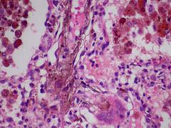 Prevention of von willebrand disease
