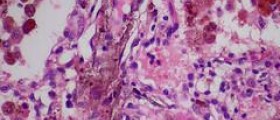 Prevention of von willebrand disease