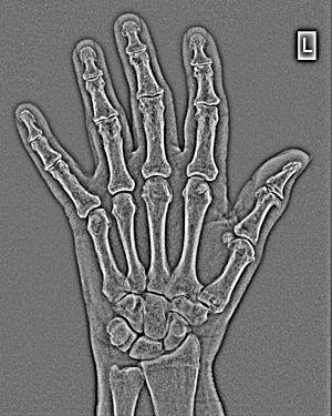Prevention of wrist fracture