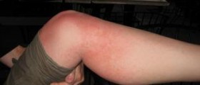 Prickly heat rash