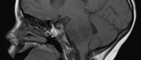 Primary brain tumours in children
