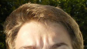 Procedures and techniques for restoring hair loss