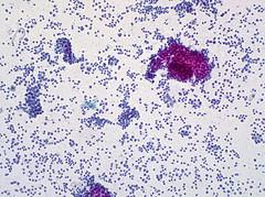 Prognosis for Niemann-Pick Type C Disease