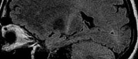 Progression of ALS symptoms