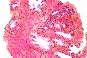Prostate cancer survival