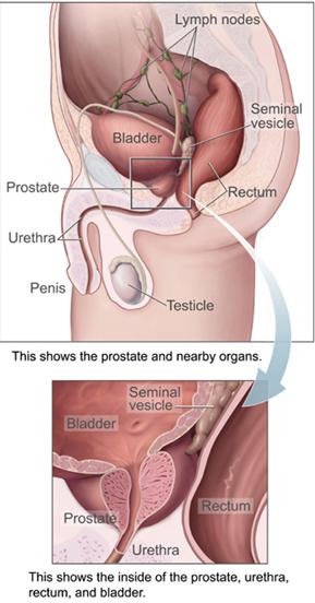 Prostate surgery recovery