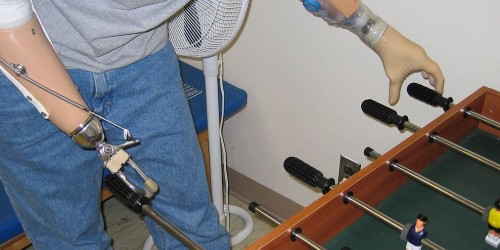 Smart Prosthetics Will Make Life More Comfortable For Amputees