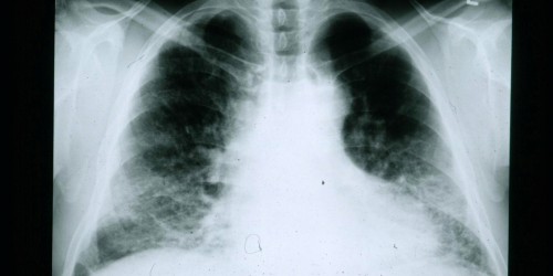 Four Lung Diseases You May Not Be Aware Of