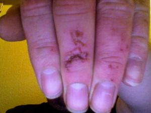 Puncture wound care