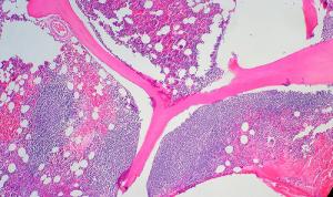 Radiation therapy for follicular lymphoma