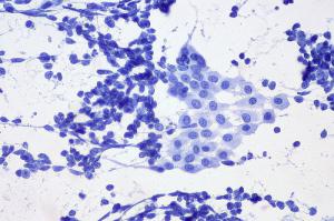 Radiation therapy for lung cancer