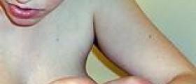 Rare skin diseases