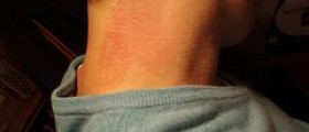 Rash on neck
