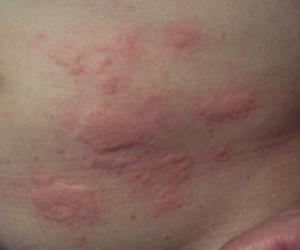 Rash on thighs