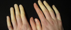 Raynaud's phenomenon