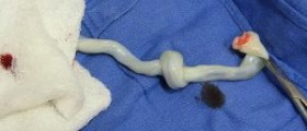 Reasons for donating umbilical cord blood
