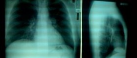 Recovery time for bacterial pneumonia