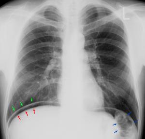 Recurrent pneumonia in children