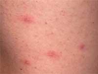 Red bumpy rash