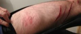 Red leg rash
