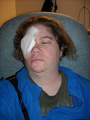 Refractive eye surgery