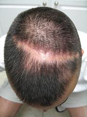 Regrow thinning hair naturally
