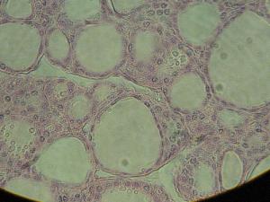 Removal of thyroid gland