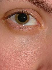 Retinopathy and diabetic macular edema