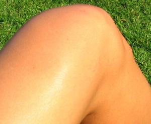 Rheumatoid arthritis in knee