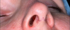 What You Should Know About Recovering from Rhinoplasty