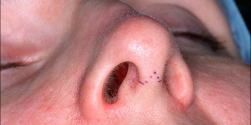 What You Should Know About Recovering from Rhinoplasty