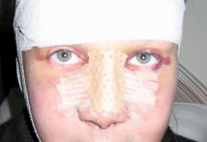 Rhinoplasty : know your nose