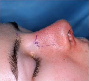 Rhinoplasty procedure facts