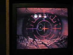 Risk and complications of LASIK eye surgery