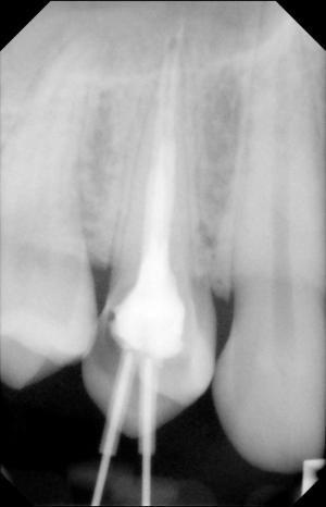 Root canal symptoms