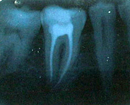 Root canal treatment