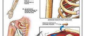 Rotator cuff exercises