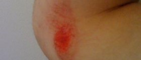 Round red rash
