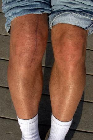 Runner's knee: Recovery time and pain management
