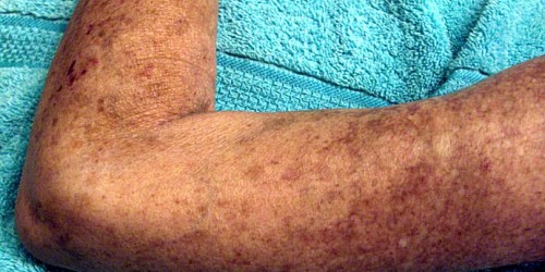 Scleroderma: An Overview
