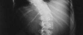 Scoliosis symptoms and treatments