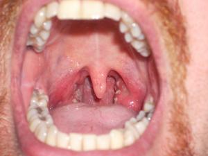 Scratchy voice remedies