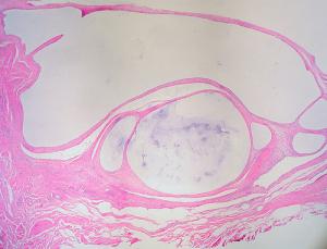 Sebaceous cyst home treatment